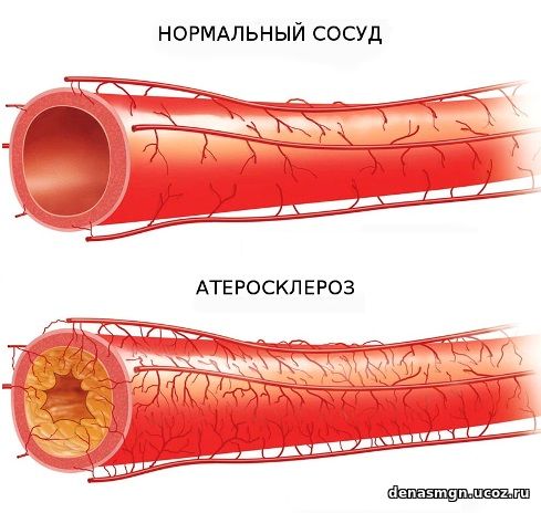 Повышенный холестерин у женщин лечение